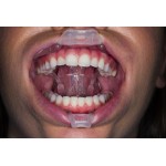 Ultradent - λευκανση - δοντια - Umbrella  Medium - Παρειοκάτοχο, γλωσσοκάτοχο, στοματοδιαστολέας Opalescence Boost 40% - Λεύκανση δοντιών στο ιατρείο